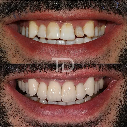 before and after emax crowns smile